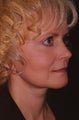 Facelift