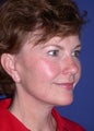 Facelift