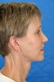 Facelift