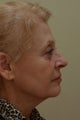 Facelift