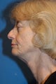 Facelift