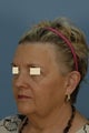 Facelift