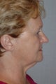 Facelift