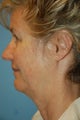 Facelift