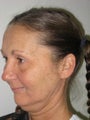Facelift