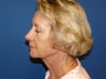Facelift