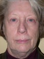 Facelift