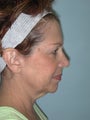 Facelift