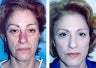 Facelift