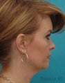 Facelift