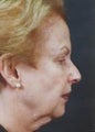 Facelift
