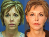 Facelift