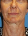 Facelift