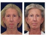 Facelift