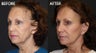 Facelift