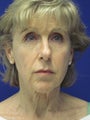 Facelift