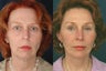 Facelift