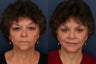 Facelift