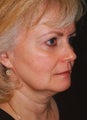Facelift