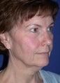 Facelift