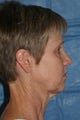 Facelift