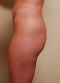 Fat transfer