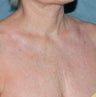Fractional laser