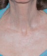 Fractional laser
