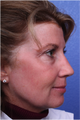 Fractional laser