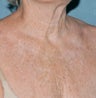 Fractional laser