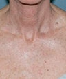 Fractional laser