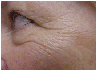 Laser resurfacing