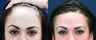 Hair Loss Treatment