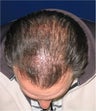 Hair transplant