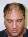 Hair transplant