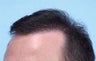 Hair transplant