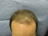 Hair transplant