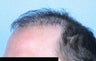 Hair transplant