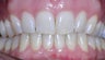 Invisalign