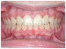 Invisalign