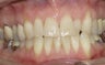 Invisalign