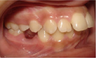 Invisalign