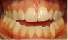 Invisalign