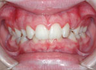 Invisalign