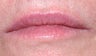 Juvederm