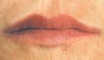 Juvederm