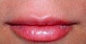Juvederm