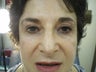 Juvederm