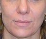 Juvederm