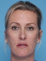 Juvederm